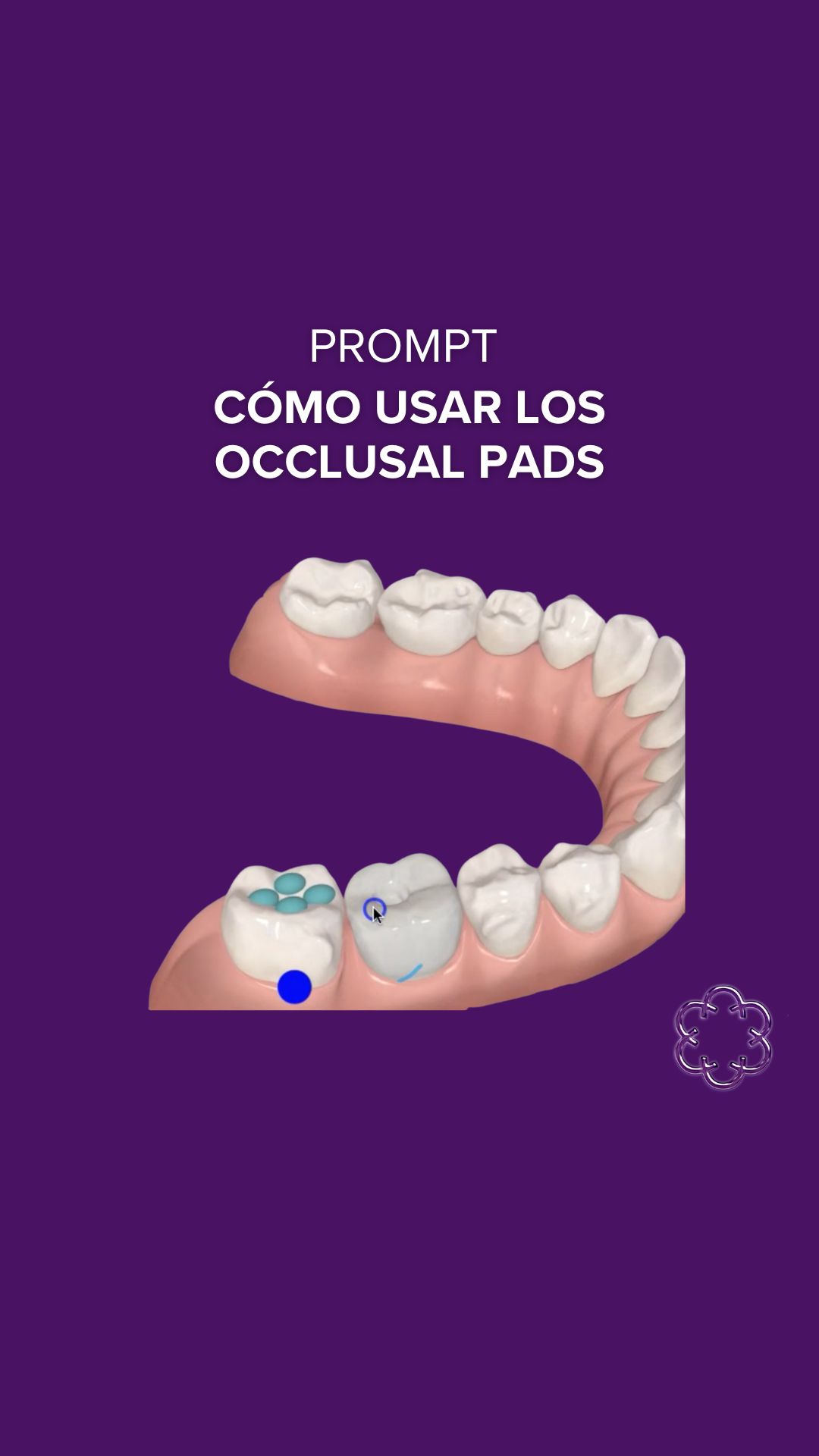Occlusal pads and how to use them.