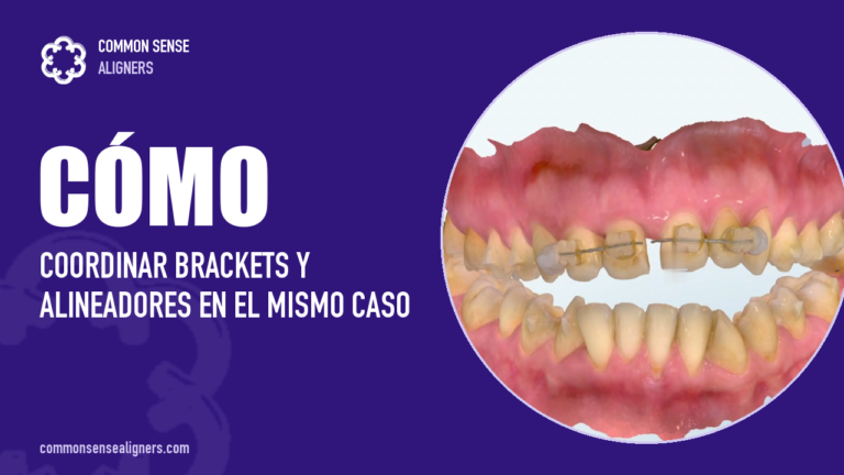 Modelo ClinCheck de un caso coordinando brackets y alineadores