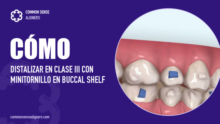 Minitornillo en buccal shelf para distalizar en la clase III