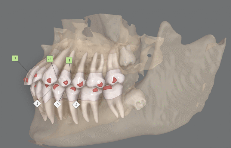 ¿Cómo afecta la distalización molar a la articulación temporomandibular?