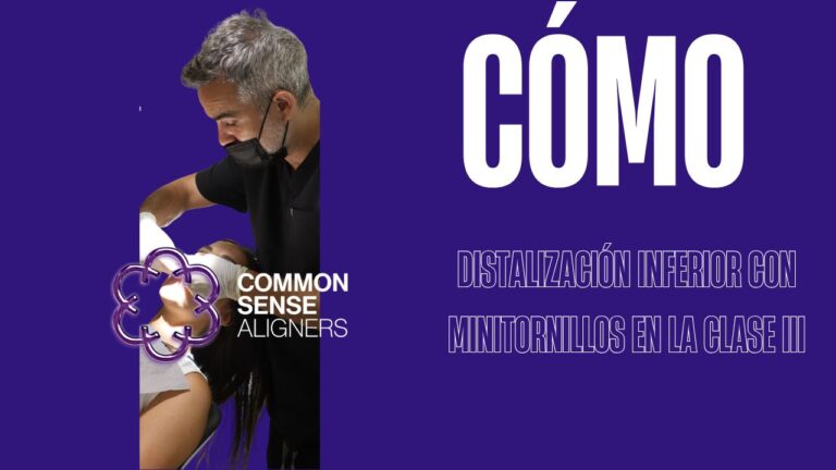 Distalización inferior con minitornillos en la clase III