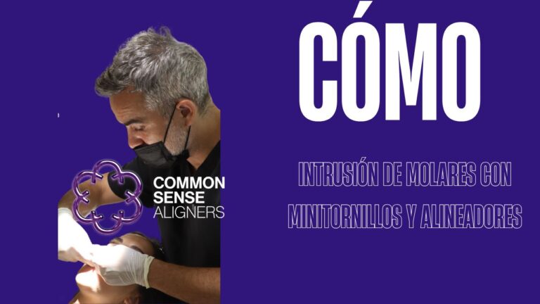 Intrusión de molares con minitornillos para cerrar una mordida abierta