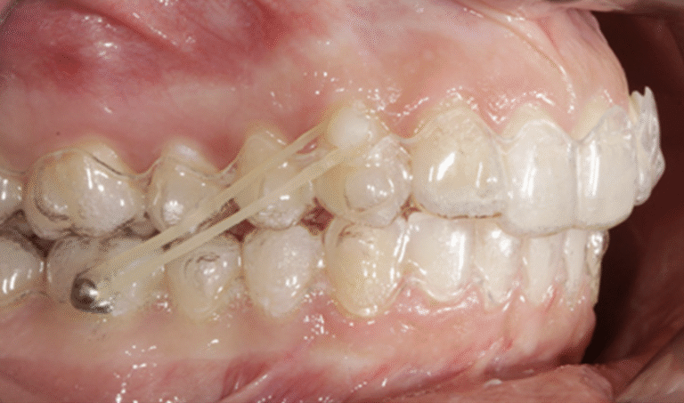 ¿Qué efecto tienen los elásticos en incisivos inferiores con Brackets y alineadores?